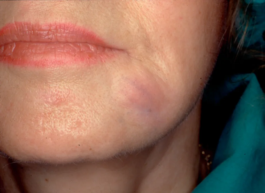 Fig 8. Granuloma de silicona en mentón lateral